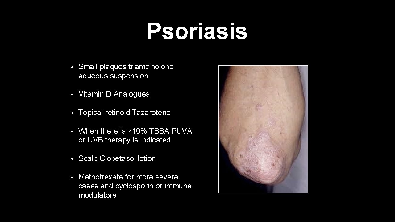 Psoriasis • Small plaques triamcinolone aqueous suspension • Vitamin D Analogues • Topical retinoid