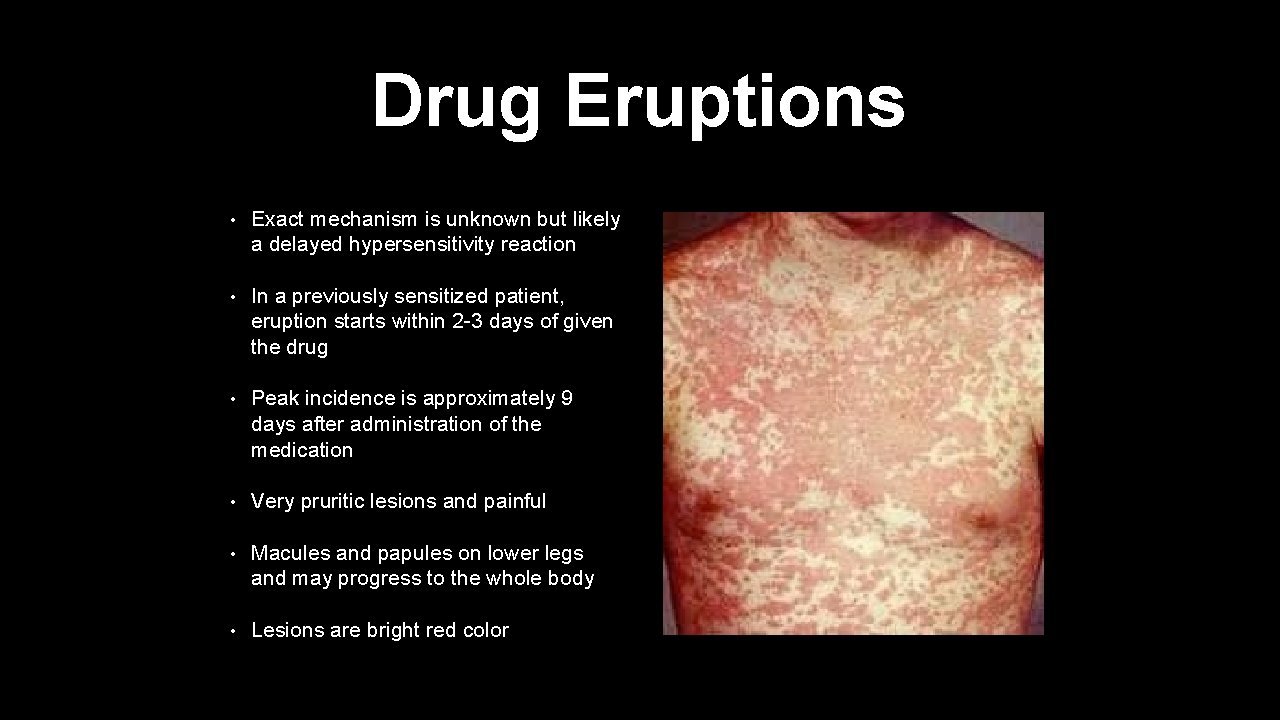 Drug Eruptions • Exact mechanism is unknown but likely a delayed hypersensitivity reaction •
