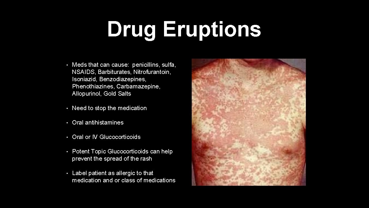 Drug Eruptions • Meds that can cause: penicillins, sulfa, NSAIDS, Barbiturates, Nitrofurantoin, Isoniazid, Benzodiazepines,