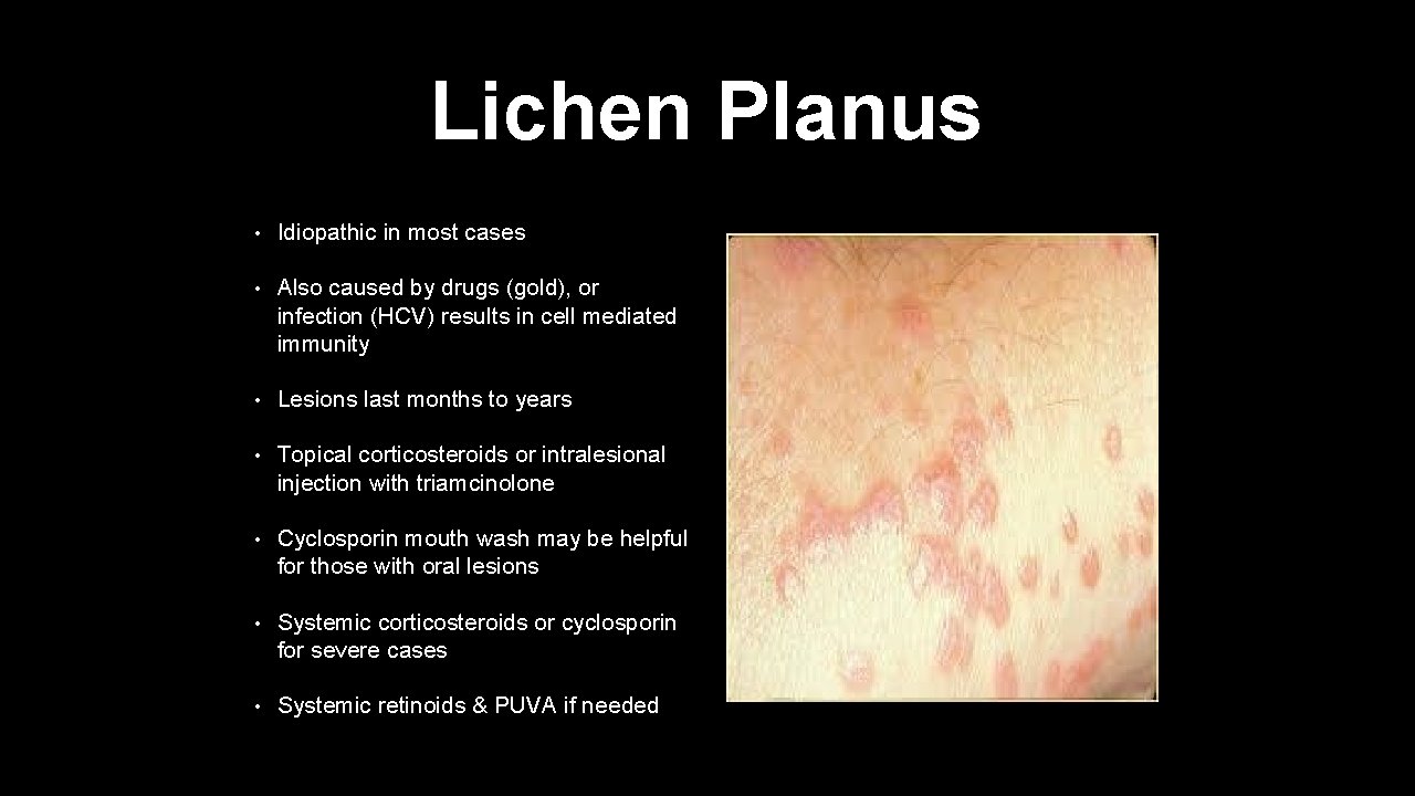 Lichen Planus • Idiopathic in most cases • Also caused by drugs (gold), or