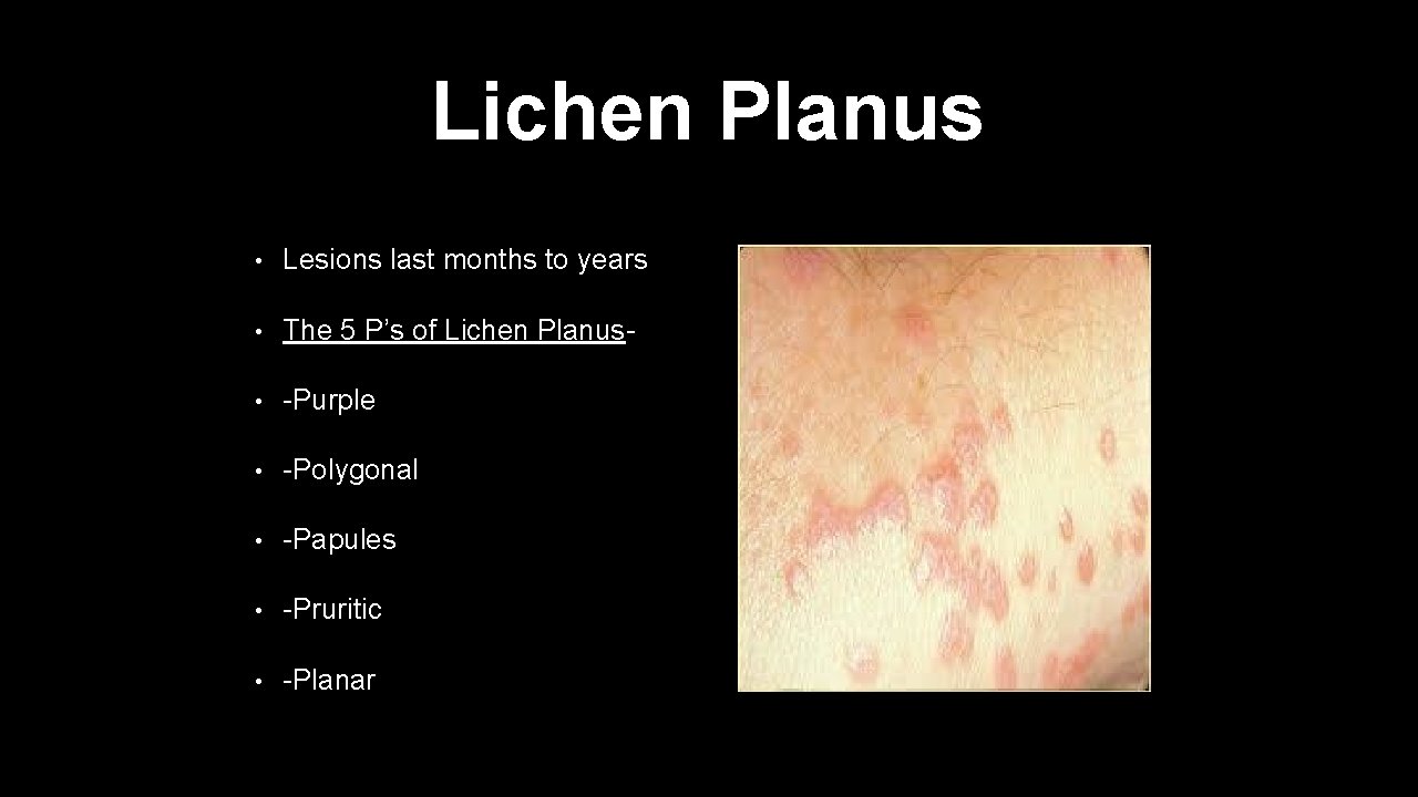 Lichen Planus • Lesions last months to years • The 5 P’s of Lichen