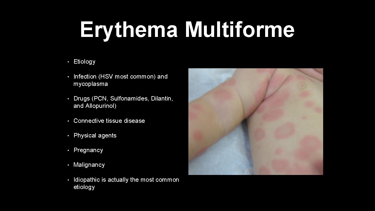 Erythema Multiforme • Etiology • Infection (HSV most common) and mycoplasma • Drugs (PCN,
