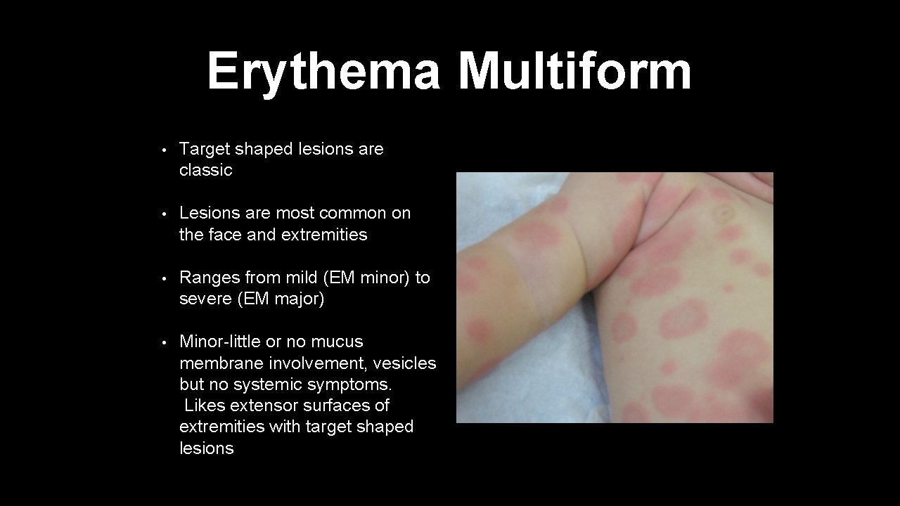 Erythema Multiform • Target shaped lesions are classic • Lesions are most common on
