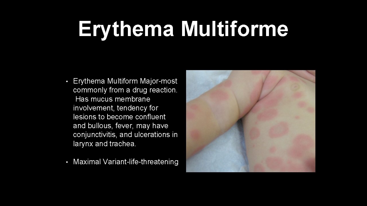 Erythema Multiforme • Erythema Multiform Major-most commonly from a drug reaction. Has mucus membrane