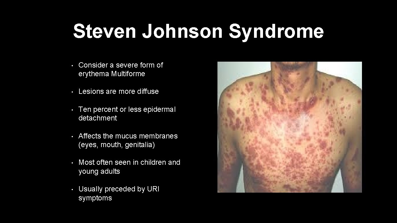 Steven Johnson Syndrome • Consider a severe form of erythema Multiforme • Lesions are