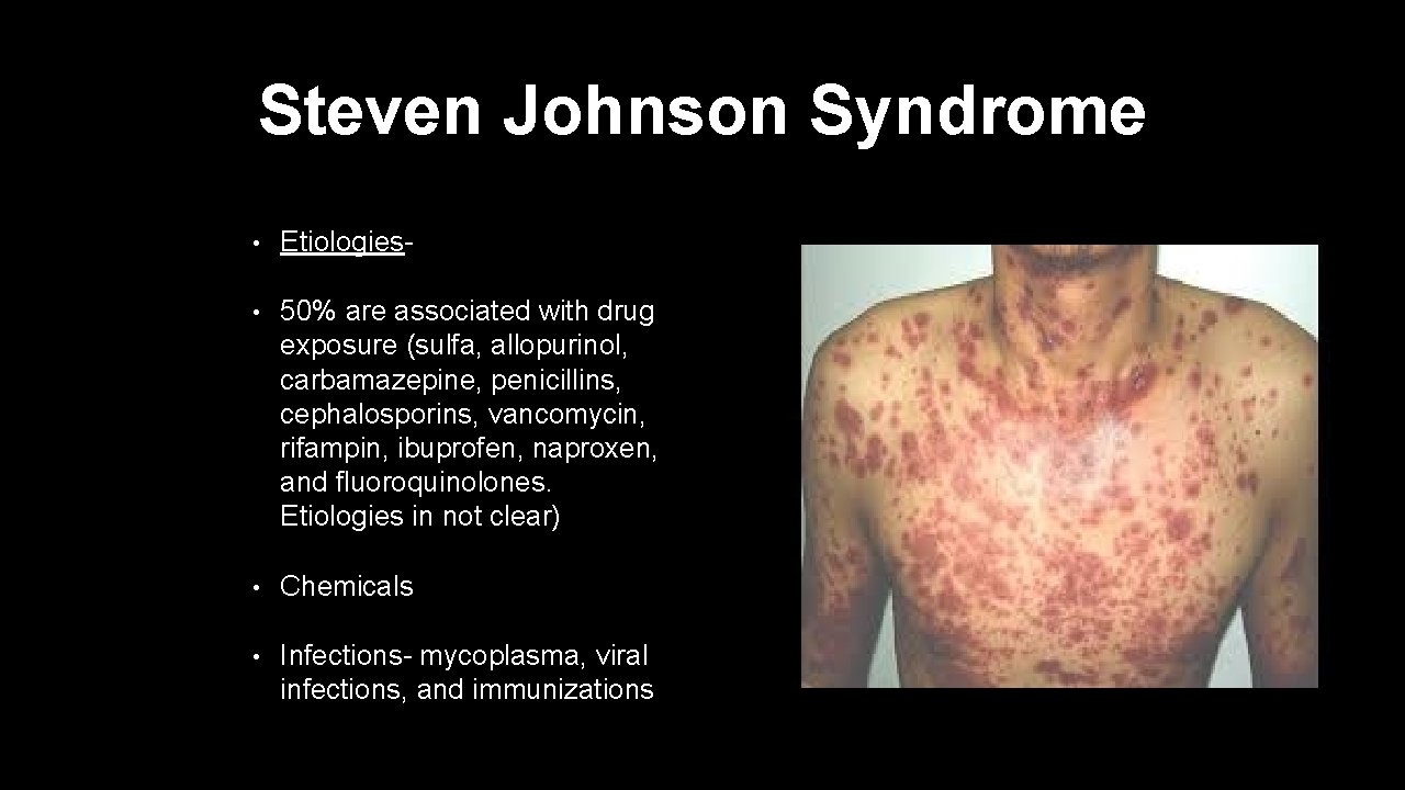 Steven Johnson Syndrome • Etiologies- • 50% are associated with drug exposure (sulfa, allopurinol,