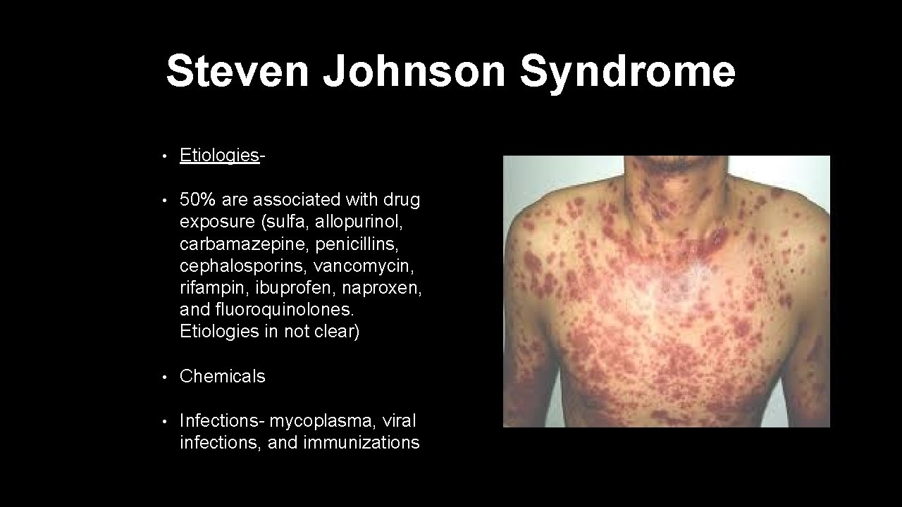 Steven Johnson Syndrome • Etiologies- • 50% are associated with drug exposure (sulfa, allopurinol,