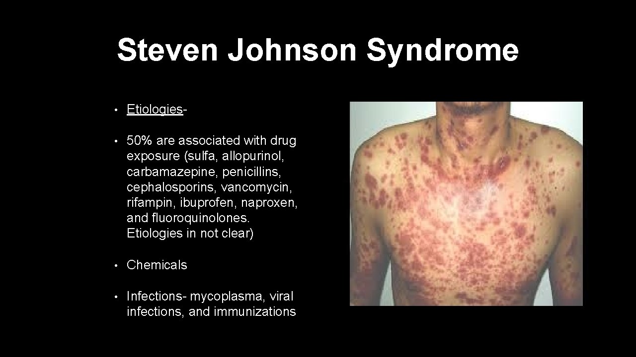 Steven Johnson Syndrome • Etiologies- • 50% are associated with drug exposure (sulfa, allopurinol,