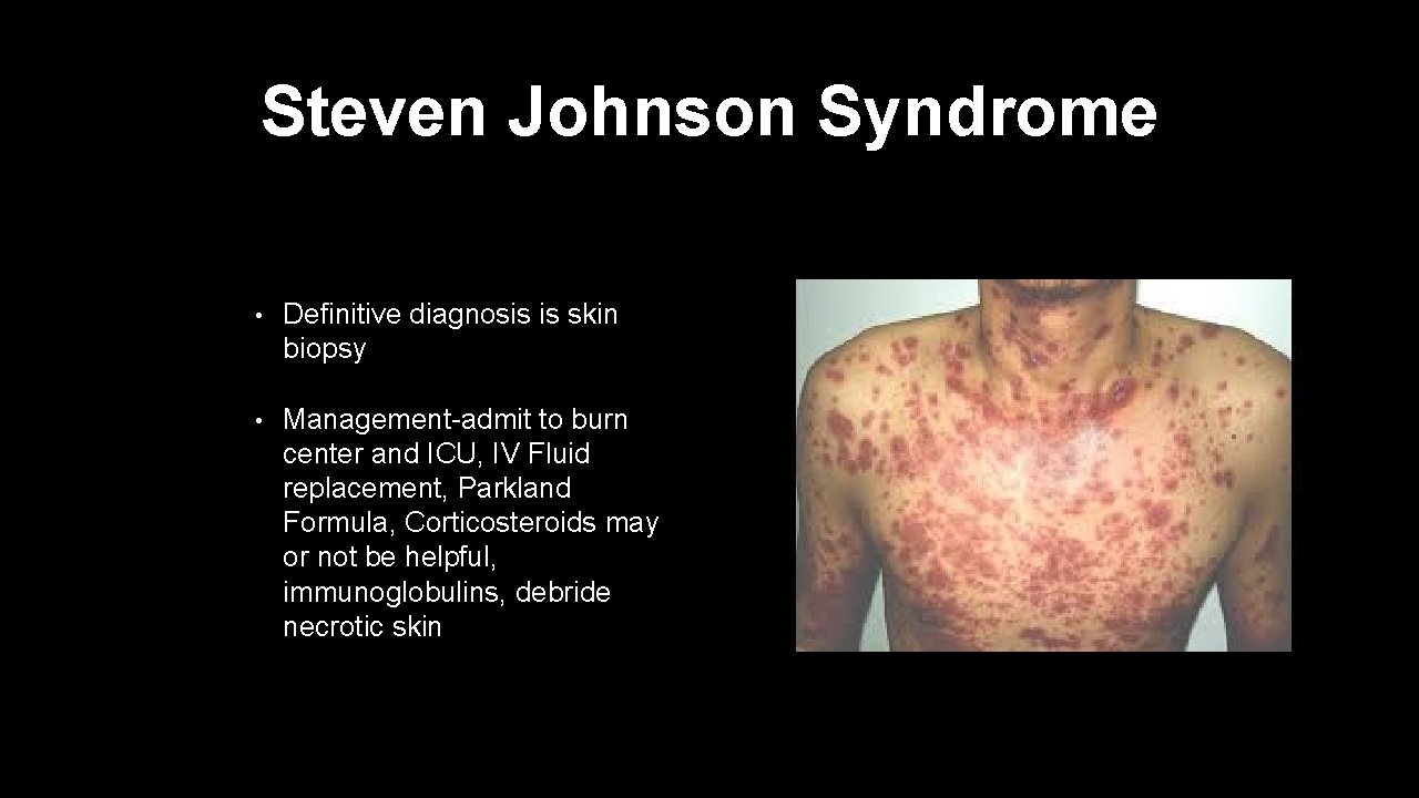 Steven Johnson Syndrome • Definitive diagnosis is skin biopsy • Management-admit to burn center