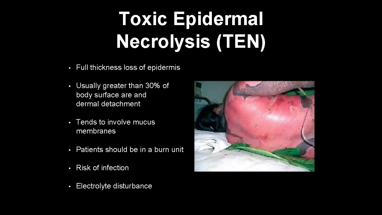 Toxic Epidermal Necrolysis (TEN) • Full thickness loss of epidermis • Usually greater than