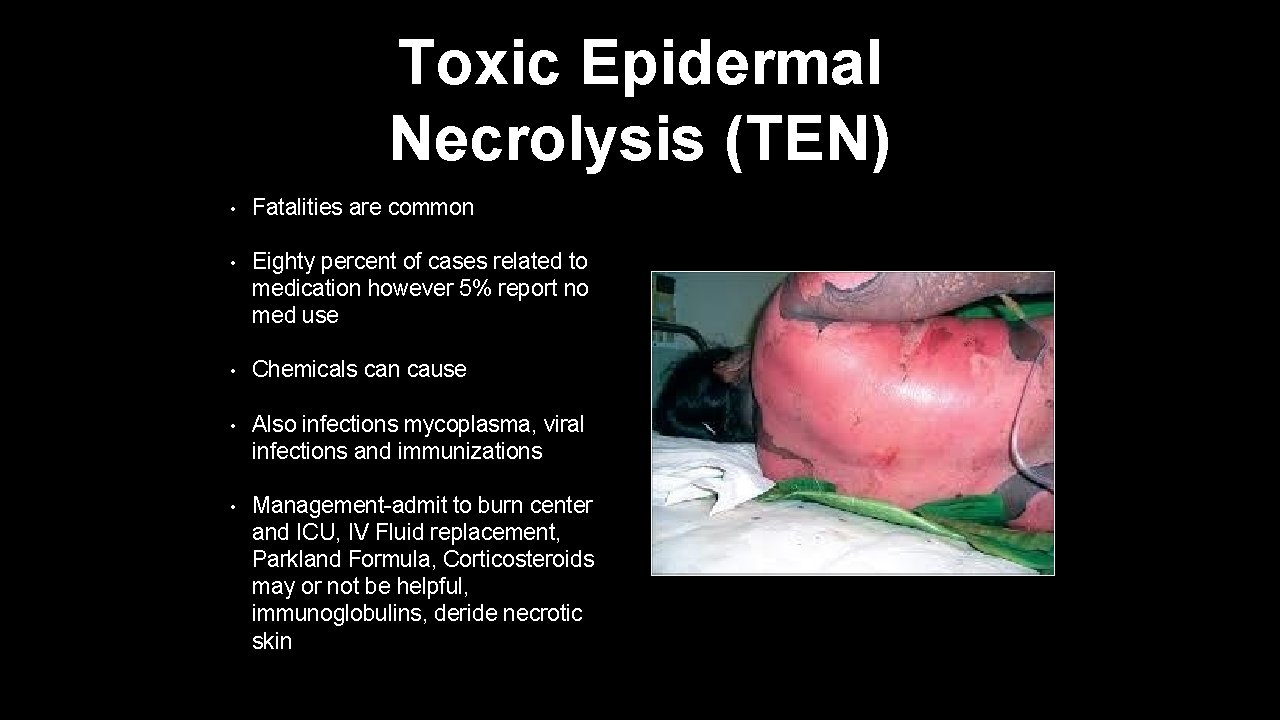 Toxic Epidermal Necrolysis (TEN) • Fatalities are common • Eighty percent of cases related