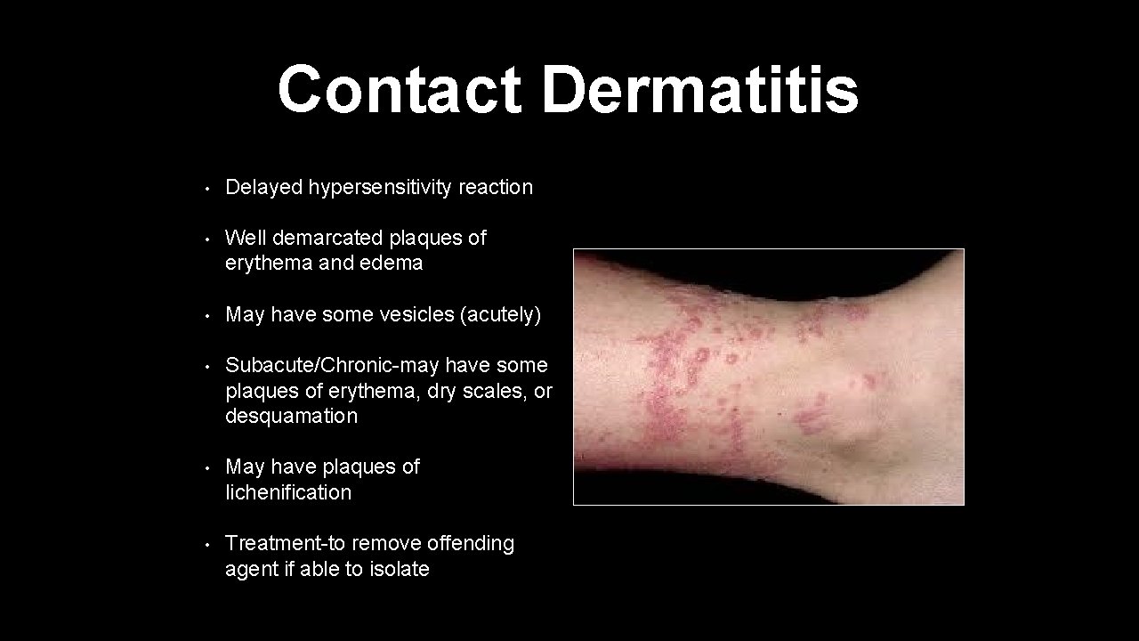 Contact Dermatitis • Delayed hypersensitivity reaction • Well demarcated plaques of erythema and edema