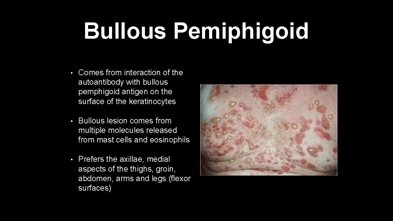 Bullous Pemiphigoid • Comes from interaction of the autoantibody with bullous pemphigoid antigen on