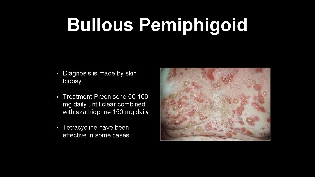 Bullous Pemiphigoid • Diagnosis is made by skin biopsy • Treatment-Prednisone 50 -100 mg