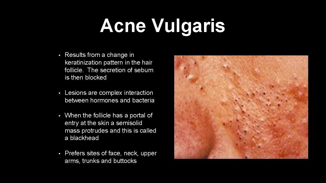 Acne Vulgaris • Results from a change in keratinization pattern in the hair follicle.