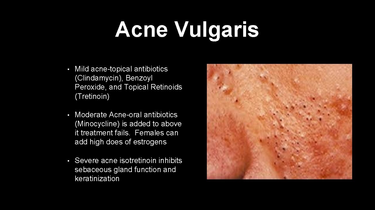 Acne Vulgaris • Mild acne-topical antibiotics (Clindamycin), Benzoyl Peroxide, and Topical Retinoids (Tretinoin) •