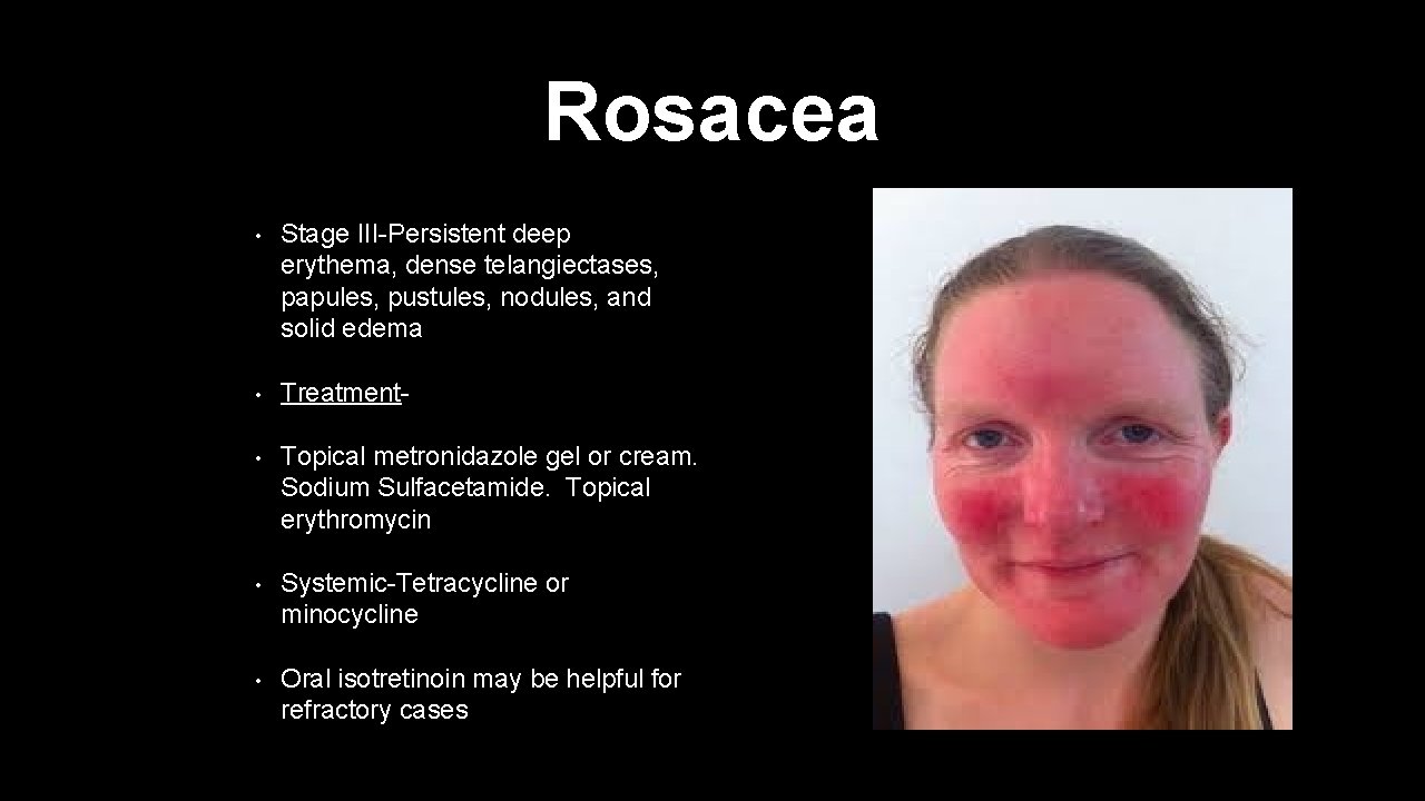 Rosacea • Stage III-Persistent deep erythema, dense telangiectases, papules, pustules, nodules, and solid edema