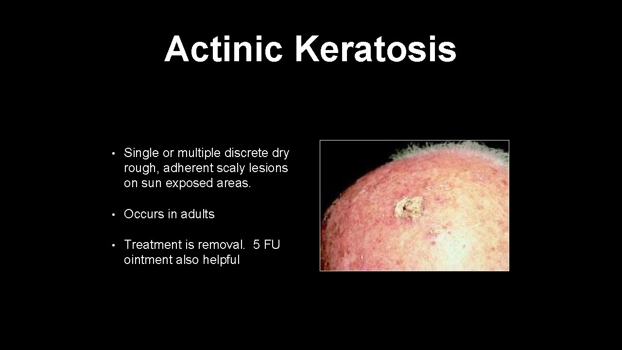 Actinic Keratosis • Single or multiple discrete dry rough, adherent scaly lesions on sun