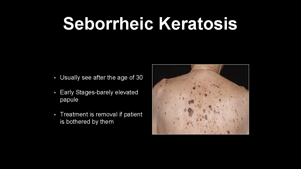 Seborrheic Keratosis • Usually see after the age of 30 • Early Stages-barely elevated