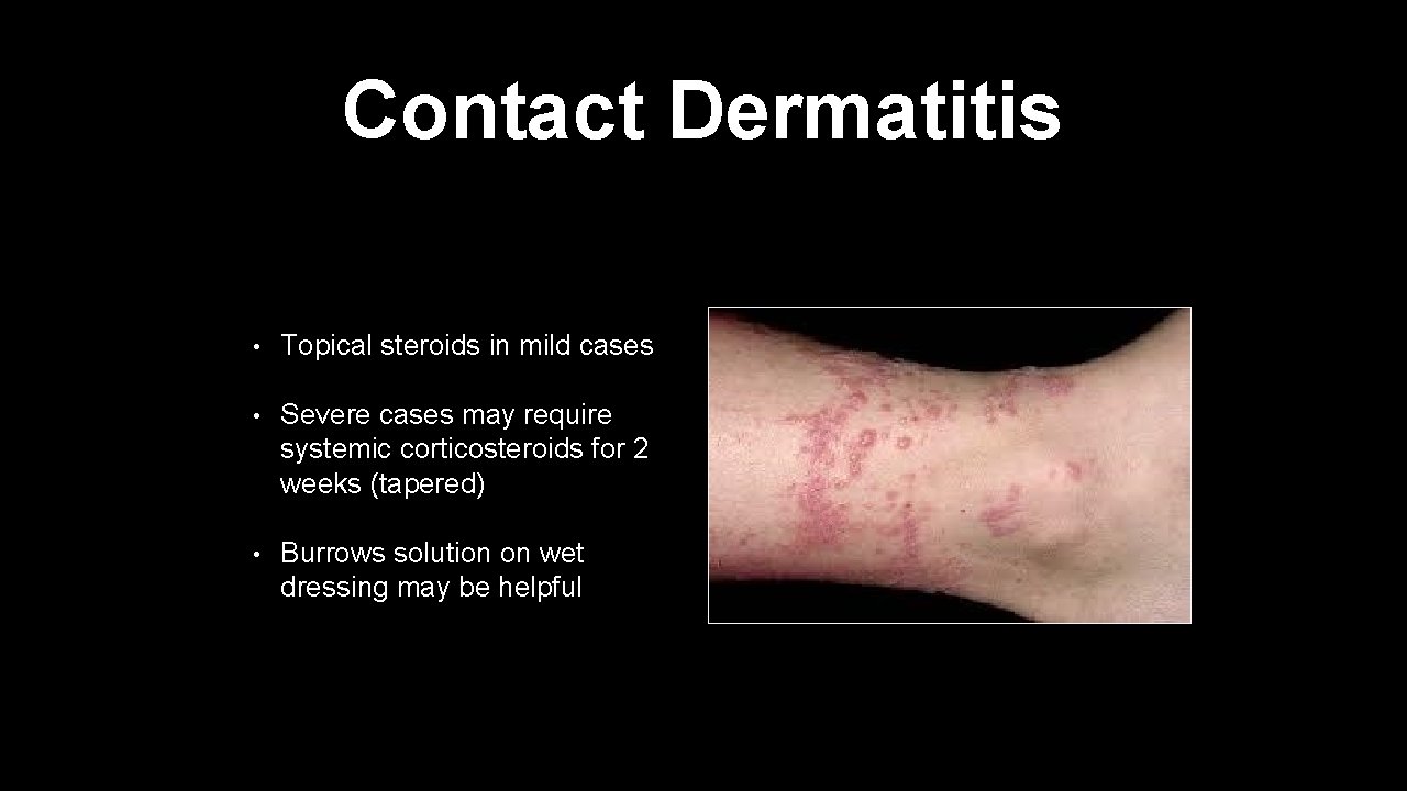 Contact Dermatitis • Topical steroids in mild cases • Severe cases may require systemic