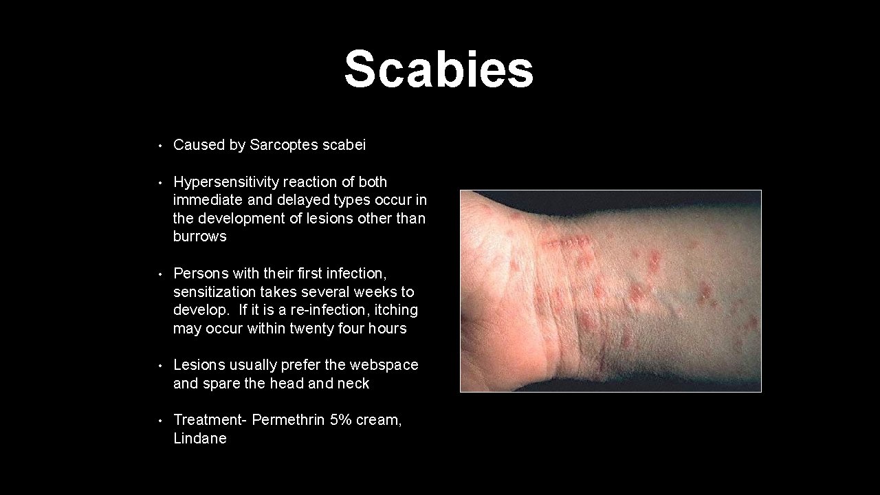 Scabies • Caused by Sarcoptes scabei • Hypersensitivity reaction of both immediate and delayed