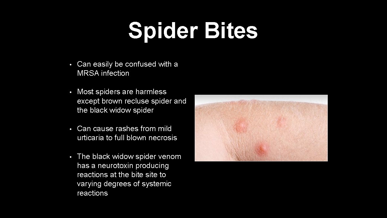 Spider Bites • Can easily be confused with a MRSA infection • Most spiders