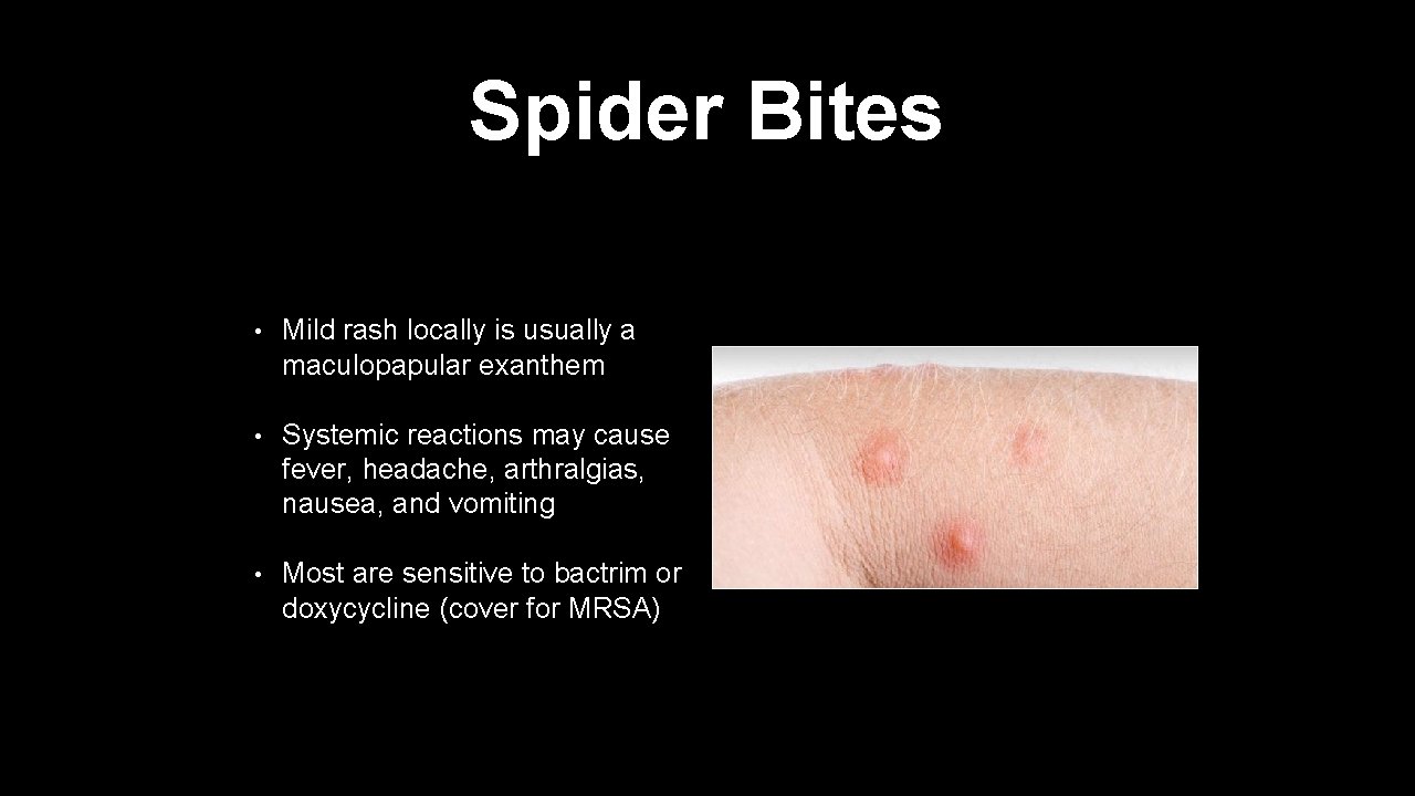 Spider Bites • Mild rash locally is usually a maculopapular exanthem • Systemic reactions