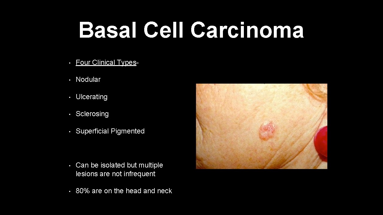 Basal Cell Carcinoma • Four Clinical Types- • Nodular • Ulcerating • Sclerosing •
