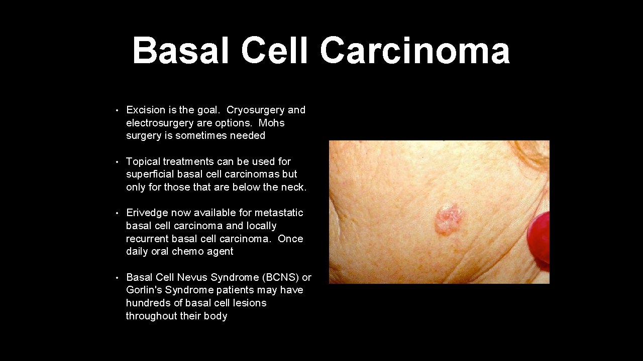 Basal Cell Carcinoma • Excision is the goal. Cryosurgery and electrosurgery are options. Mohs