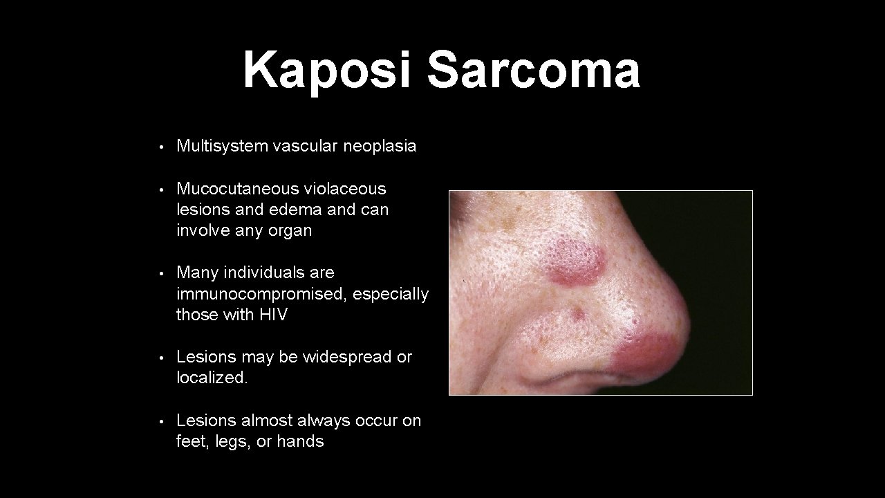 Kaposi Sarcoma • Multisystem vascular neoplasia • Mucocutaneous violaceous lesions and edema and can
