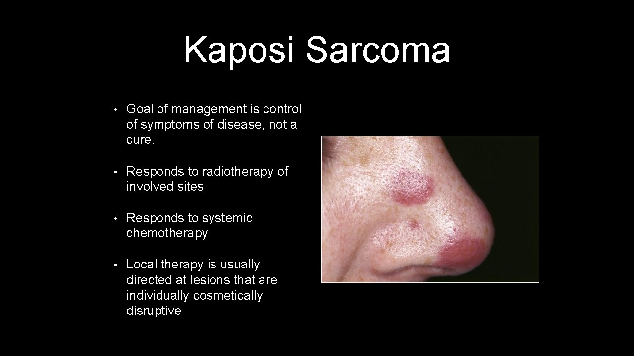 Kaposi Sarcoma • Goal of management is control of symptoms of disease, not a