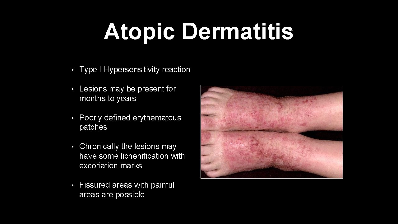 Atopic Dermatitis • Type I Hypersensitivity reaction • Lesions may be present for months