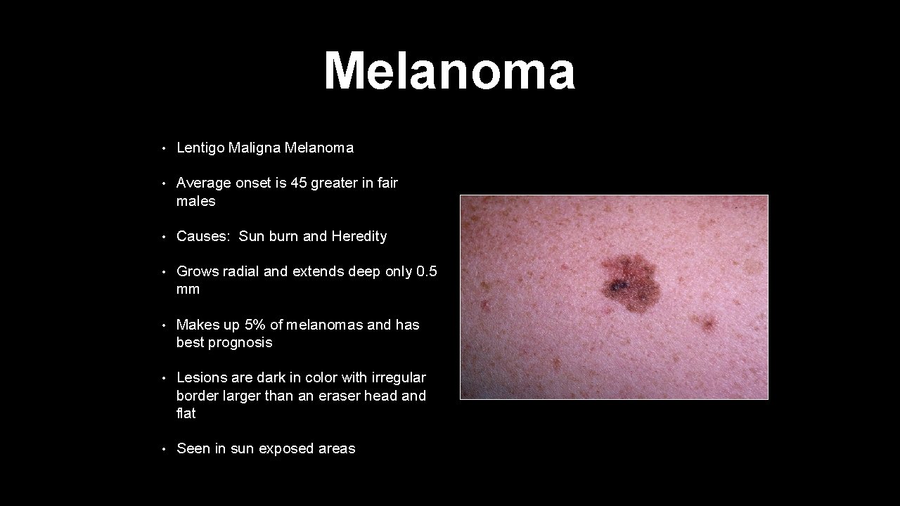 Melanoma • Lentigo Maligna Melanoma • Average onset is 45 greater in fair males