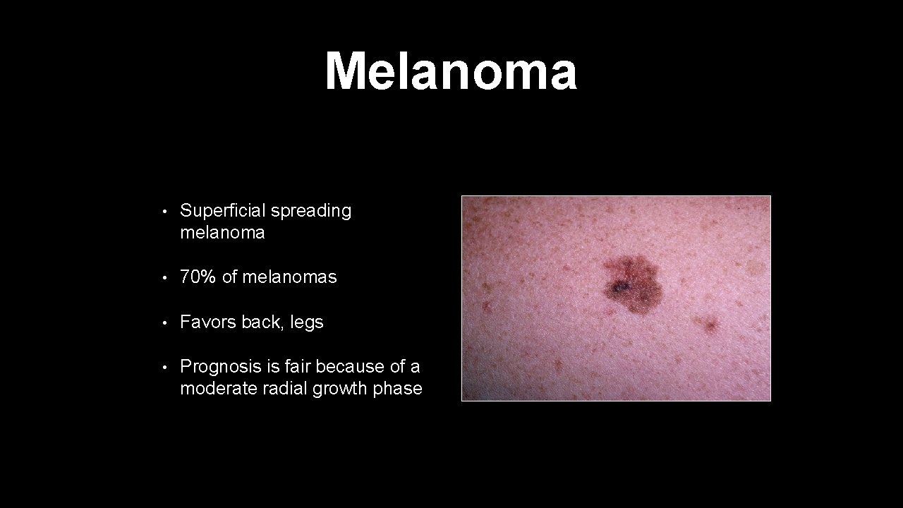 Melanoma • Superficial spreading melanoma • 70% of melanomas • Favors back, legs •