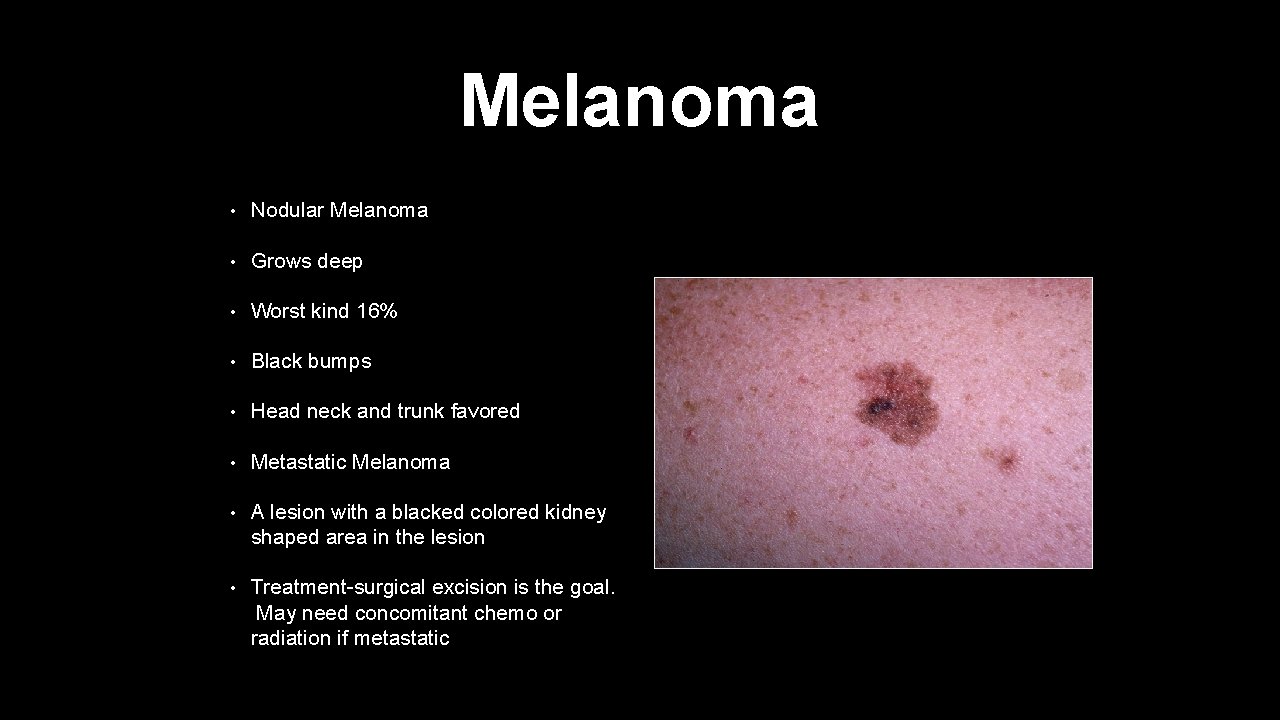 Melanoma • Nodular Melanoma • Grows deep • Worst kind 16% • Black bumps