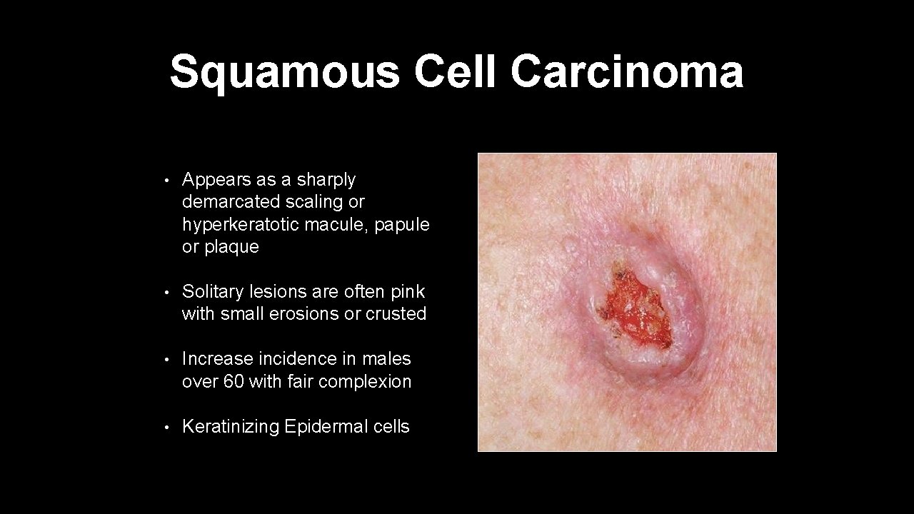 Squamous Cell Carcinoma • Appears as a sharply demarcated scaling or hyperkeratotic macule, papule