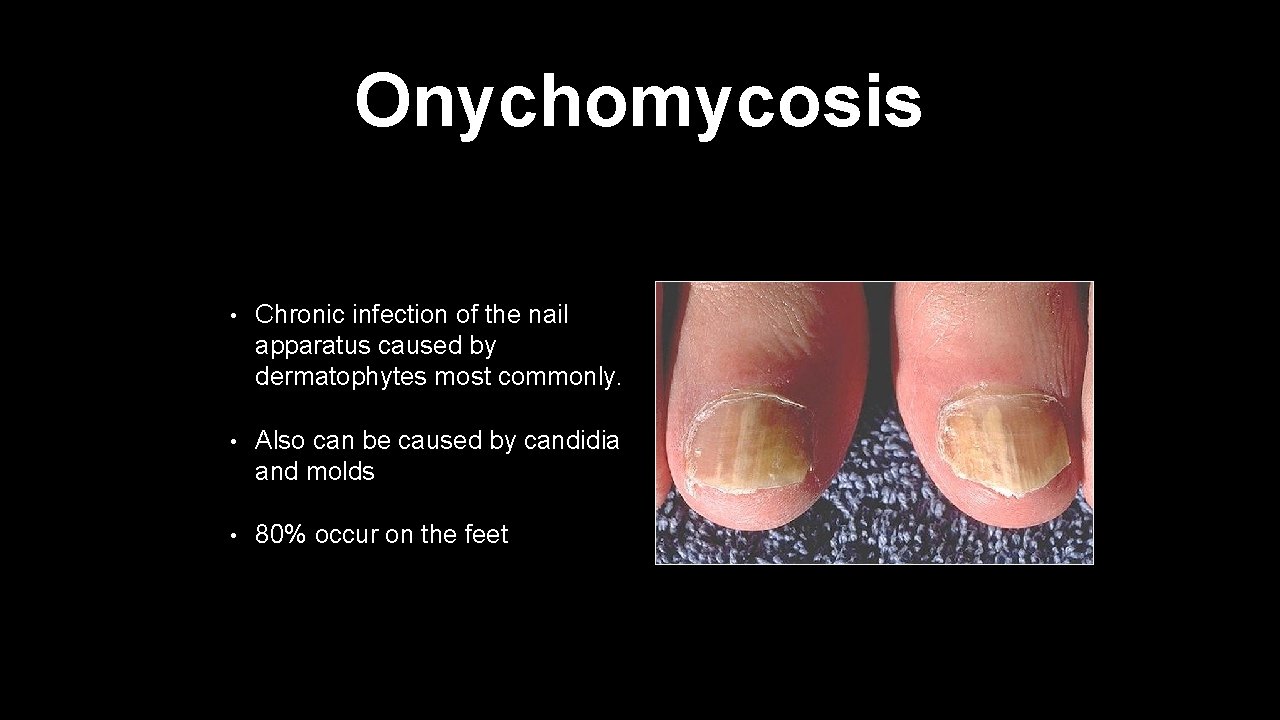 Onychomycosis • Chronic infection of the nail apparatus caused by dermatophytes most commonly. •