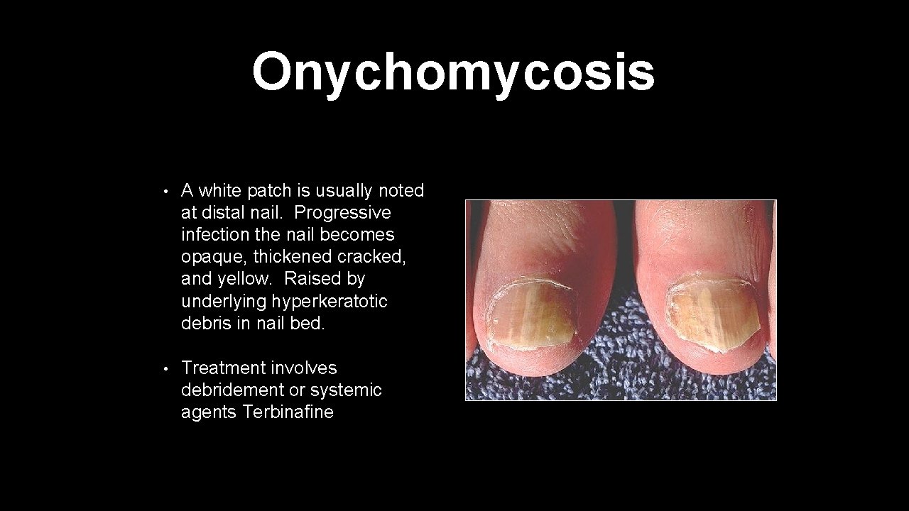 Onychomycosis • A white patch is usually noted at distal nail. Progressive infection the