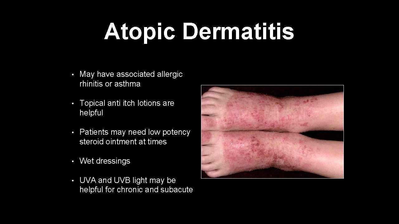 Atopic Dermatitis • May have associated allergic rhinitis or asthma • Topical anti itch
