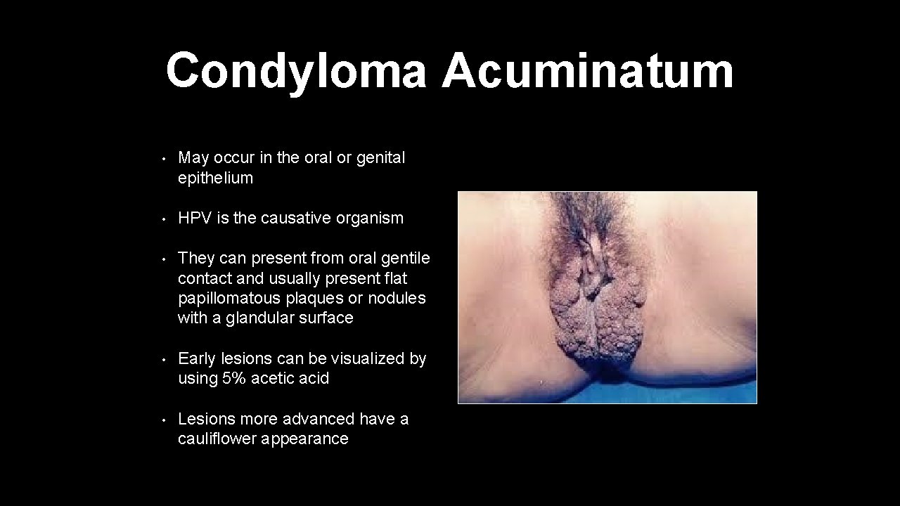 Condyloma Acuminatum • May occur in the oral or genital epithelium • HPV is