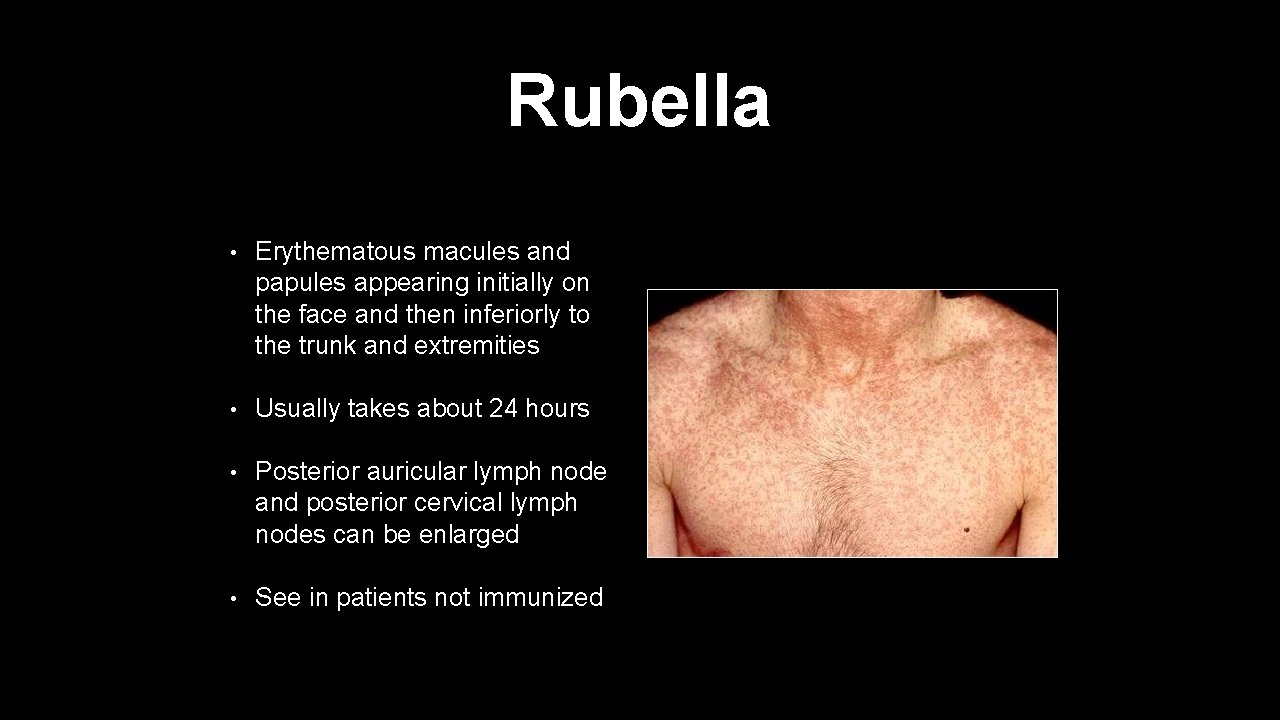 Rubella • Erythematous macules and papules appearing initially on the face and then inferiorly