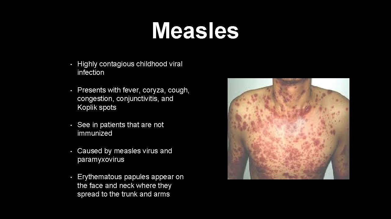 Measles • Highly contagious childhood viral infection • Presents with fever, coryza, cough, congestion,