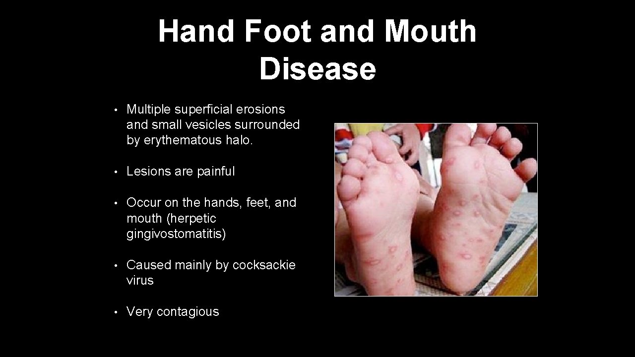 Hand Foot and Mouth Disease • Multiple superficial erosions and small vesicles surrounded by