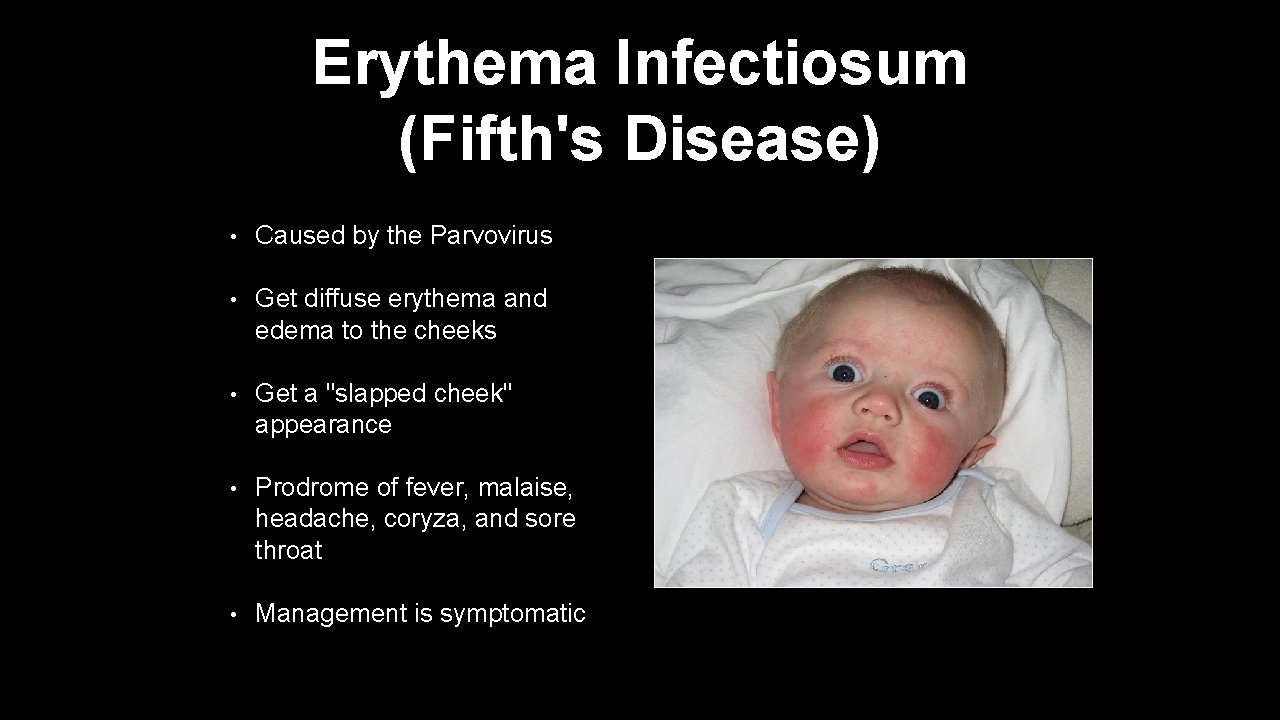 Erythema Infectiosum (Fifth's Disease) • Caused by the Parvovirus • Get diffuse erythema and