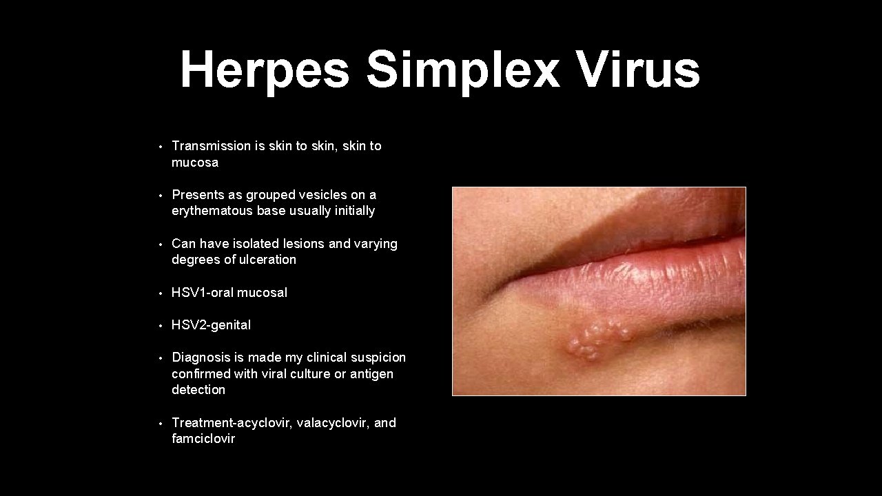 Herpes Simplex Virus • Transmission is skin to skin, skin to mucosa • Presents