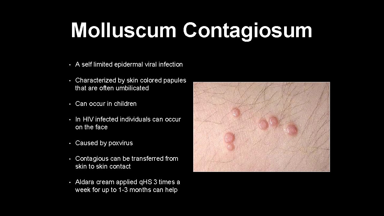 Molluscum Contagiosum • A self limited epidermal viral infection • Characterized by skin colored