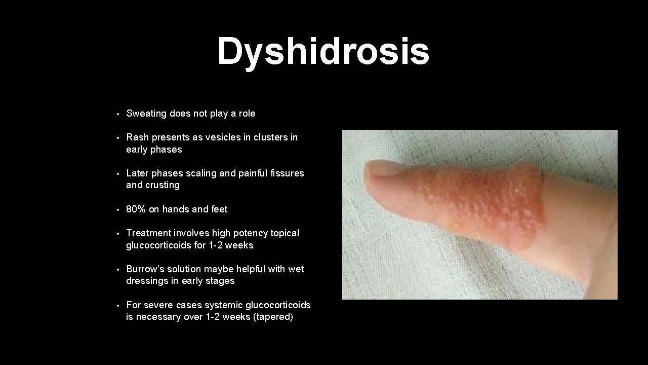 Dyshidrosis • Sweating does not play a role • Rash presents as vesicles in