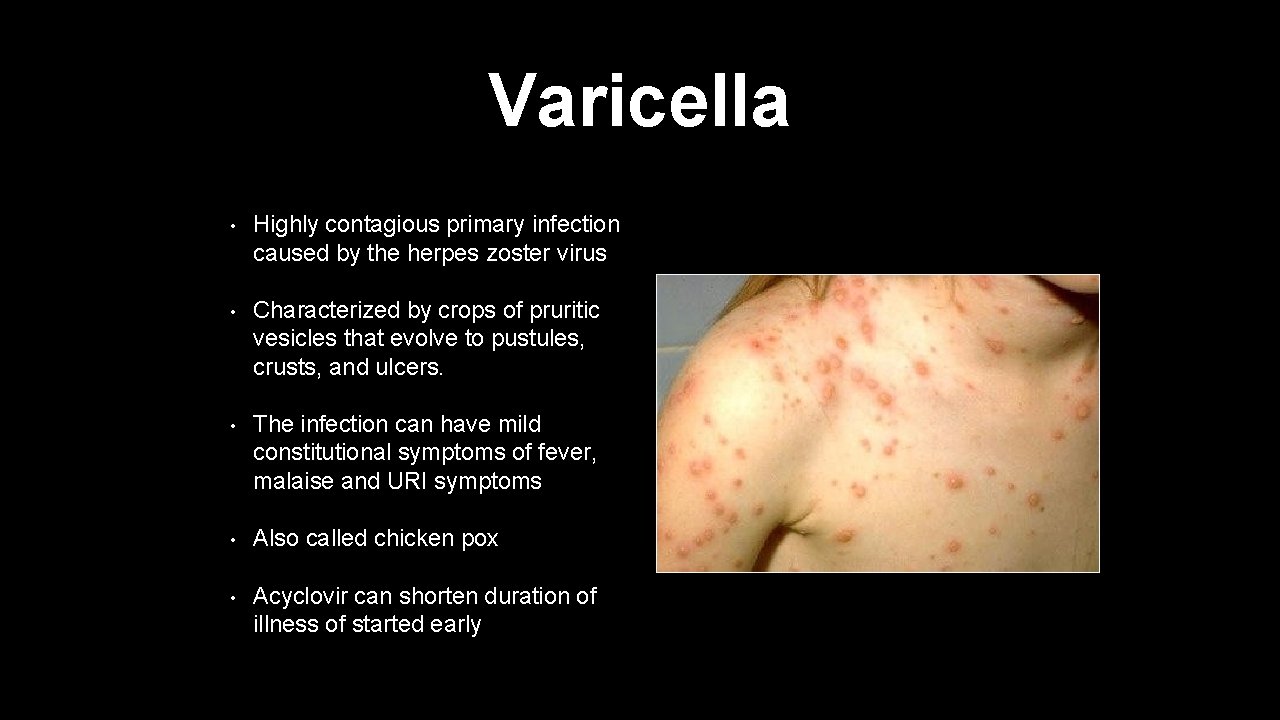 Varicella • Highly contagious primary infection caused by the herpes zoster virus • Characterized