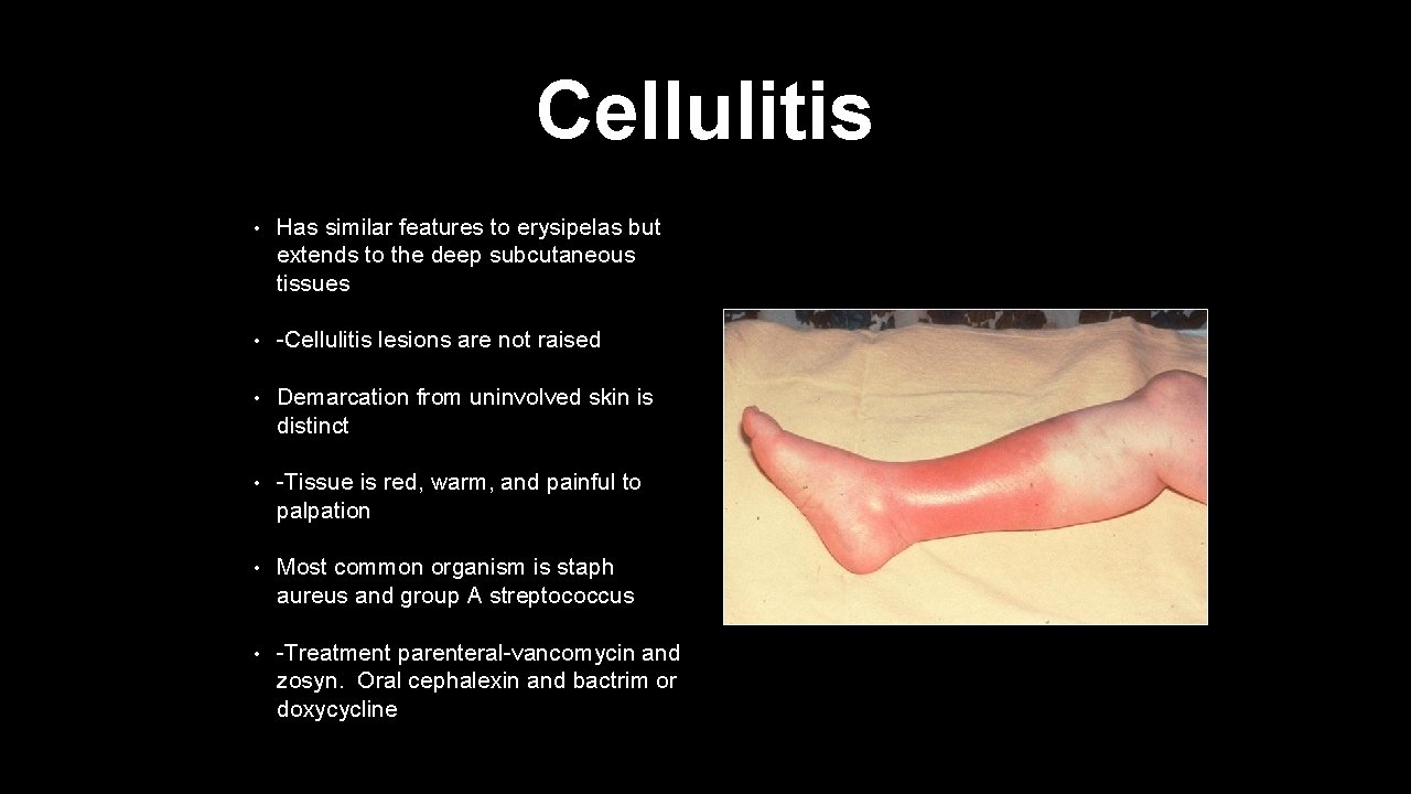 Cellulitis • Has similar features to erysipelas but extends to the deep subcutaneous tissues