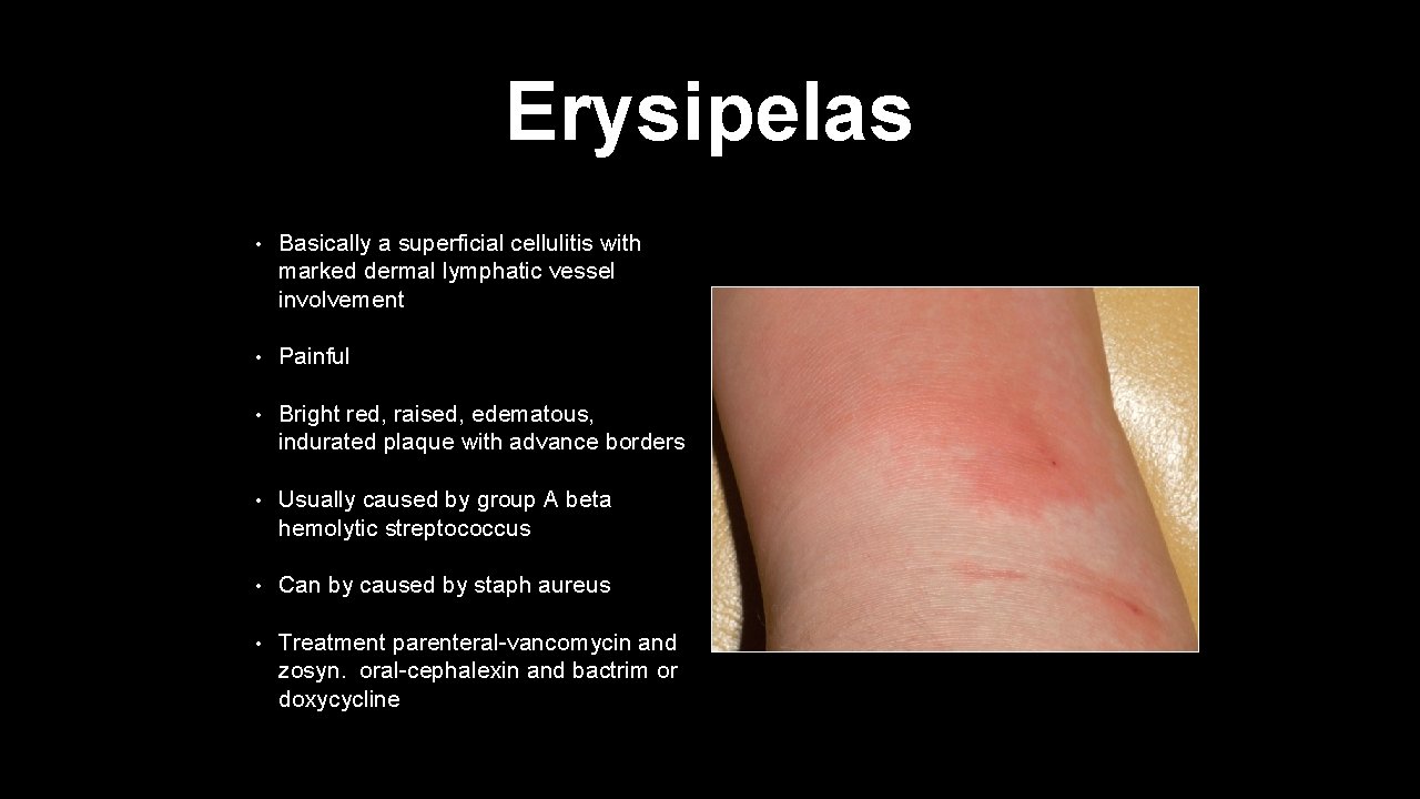 Erysipelas • Basically a superficial cellulitis with marked dermal lymphatic vessel involvement • Painful